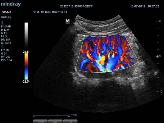 Adult Kidney Color Flow